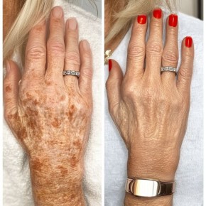 Как вернуть коже ровный тон: 4 продукта, помогающие избавиться от старческих пятен